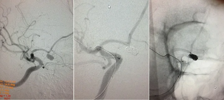 Coiling of ruptured Acom aneurysm