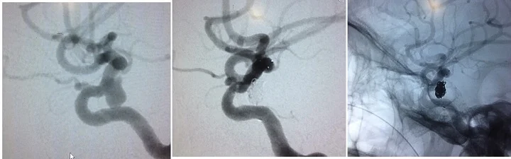Stent-assisted coiling of ICA aneurysm