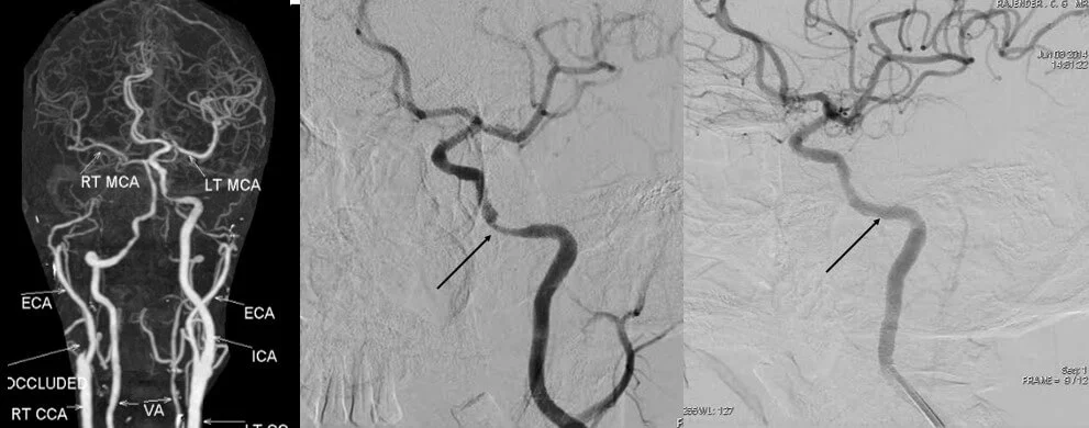 Stenting for intracranial stenosis