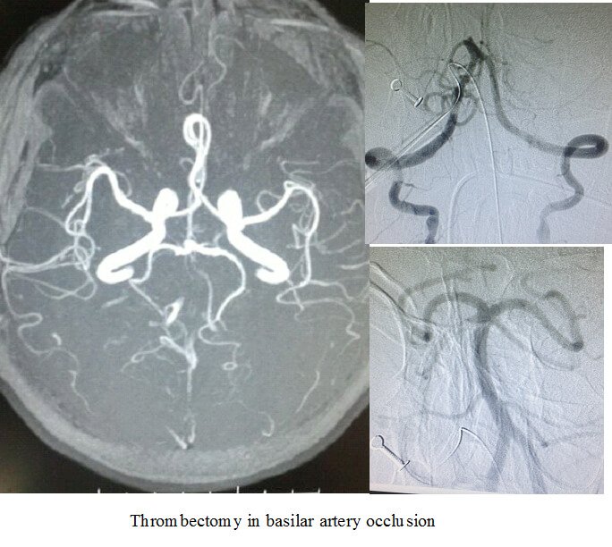 Hemorrhagic Stroke Treatment in Hyderabad