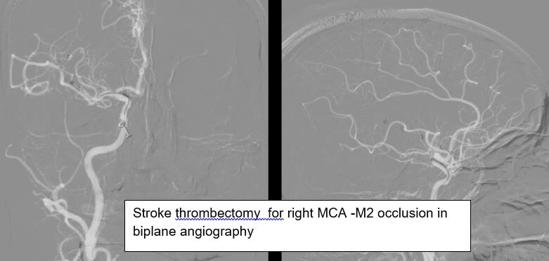 Stroke Thrombectomy with Bi-Plane Technology