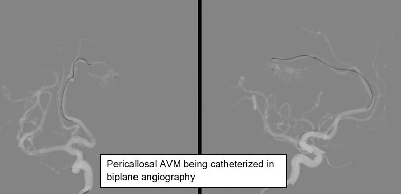 AVM Embolization with Bi-Plane Technology