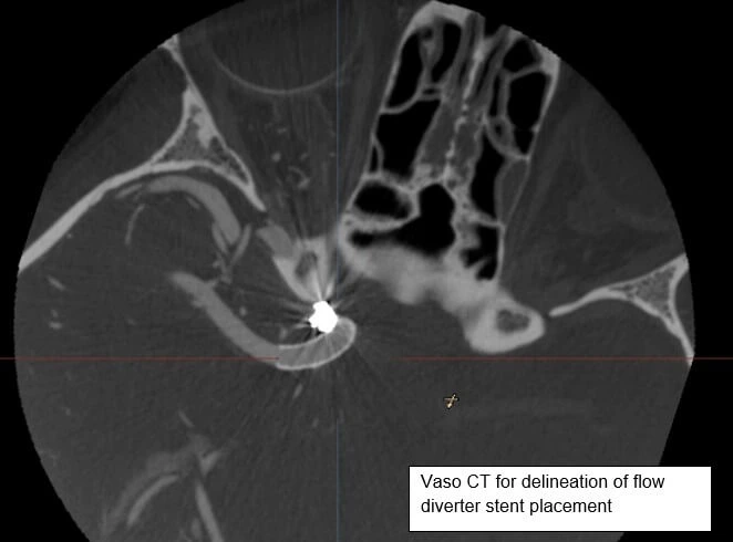Vaso CT Stent Assessment Software