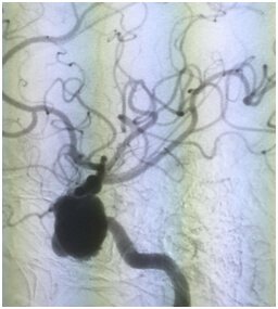 Brain Embolization Treatment in Hyderabad