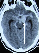 Coiling For Aneurysms Treatment in Hyderabad