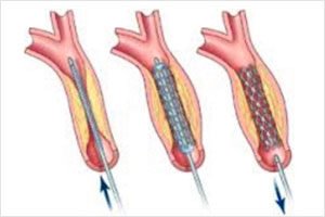 Carotid Stenting Treatment in Hyderabad