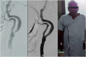 Carotid Cavernous Fistula Treatment in Hyderabad