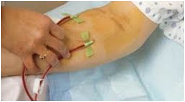 Vascular Interventional Treatments in Hyderabad