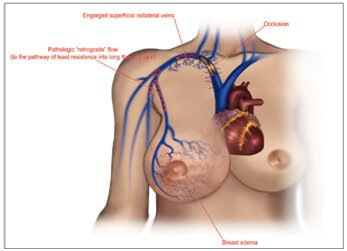 Sclerotherapy Procedure in Hyderabad