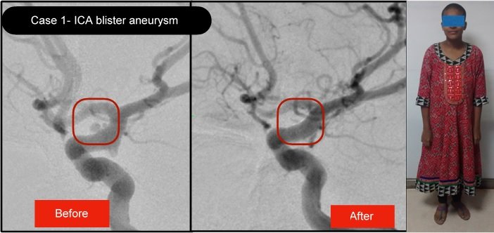 ICA blister aneurysm treated with flow diverter