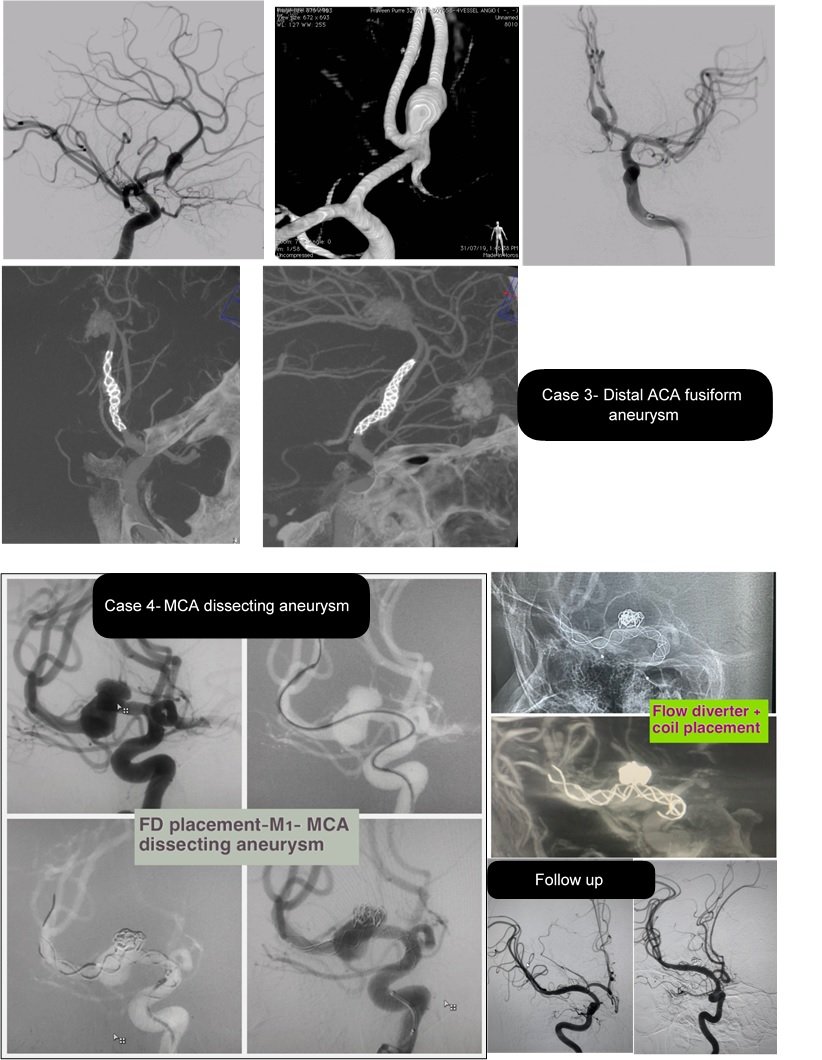 Distal ACA fusiform aneurysm treated with flow diverter