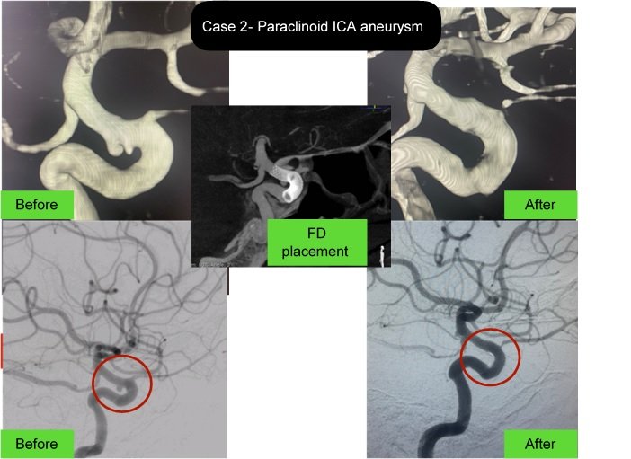Paraclinoid ICA aneurysm treated with flow diverter