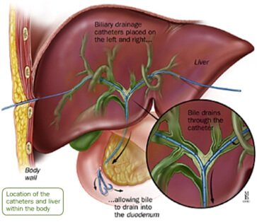 Biliary Intervention Treatment in Hyderabad