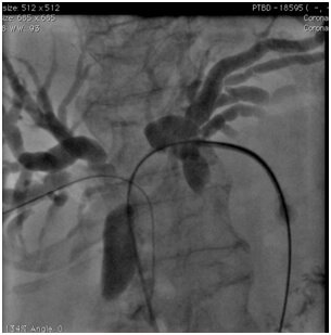 Biliary Drainage Treatment in Hyderabad