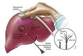 Liver Cancer Treatments in Hyderabad