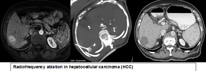 Liver Ablation Treatment in Hyderabad