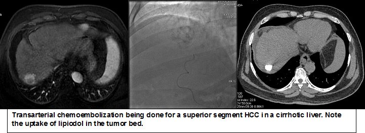 TACE Procedure in Hyderabad