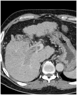 Liver Stenting Procedure in Hyderabad