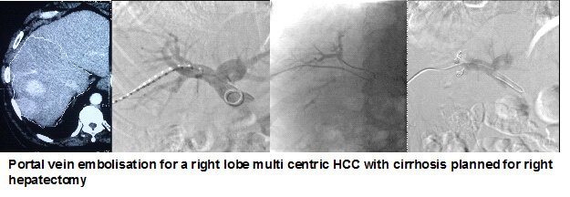 Portal Vein Embolization in Hyderabad