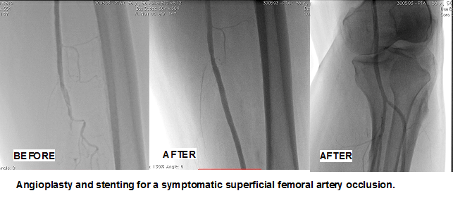 Peripheral Vascular Disease Case in Hyderabad
