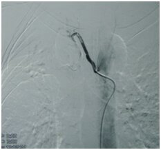 Embolization Procedure for AVM in Hyderabad