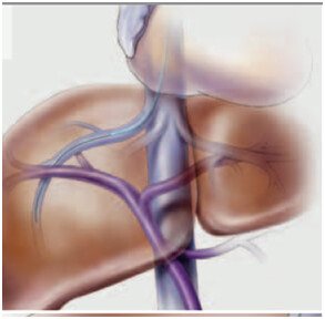 TIPSS Procedure in Hyderabad
