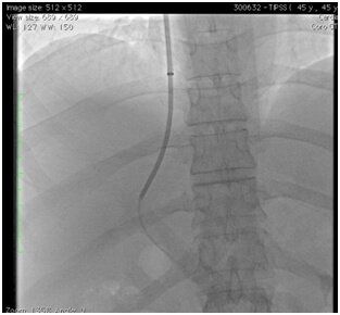 TIPSS Procedure for Refractory Ascites in Hyderabad