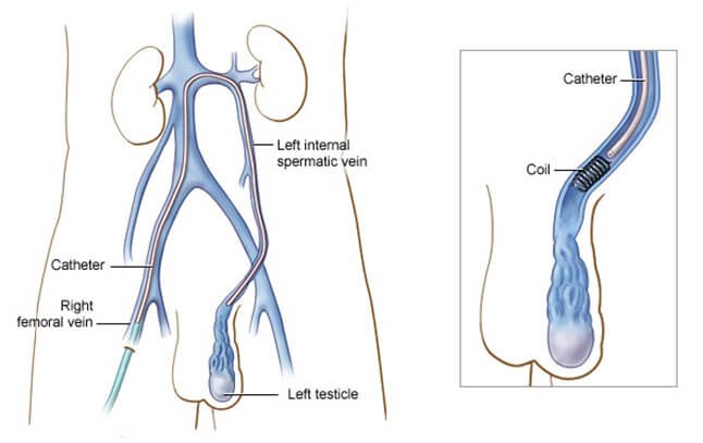 Varicocele Embolization Procedure in Hyderabad