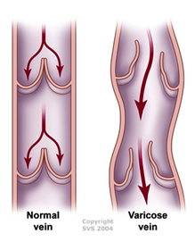 Endovenous Ablation Treatment in Hyderabad