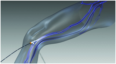 Radiofrequency Ablation for Varicose Veins in Hyderabad