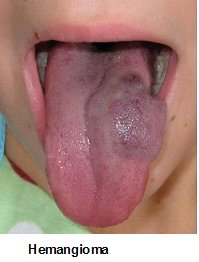 Vascular Malformations Treatment in Hyderabad