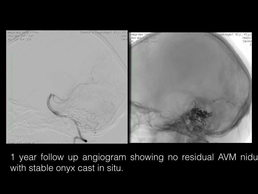 Complete Cure of a Ruptured Cerebellar AVM by Endovascular Embolisation