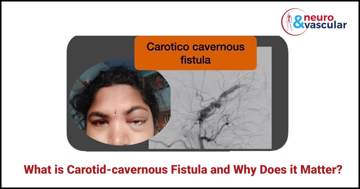 What is Carotid Cavernous Fistula and Why Does it Matter?