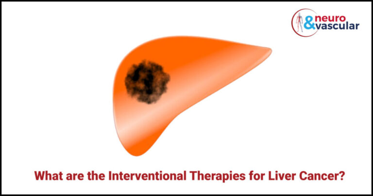 What Are The Interventional Therapies For Liver Cancer 6461