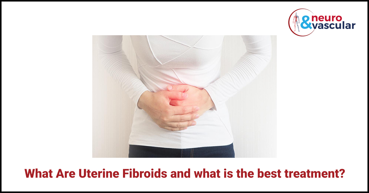 What Are Uterine Fibroids and what is the best treatment?