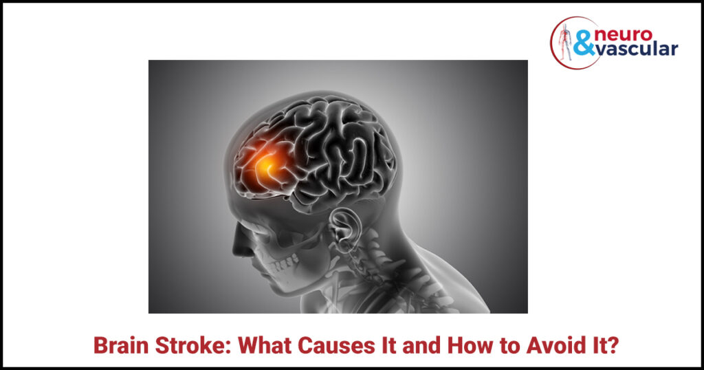 Brain Stroke: What Causes It and How to Avoid It?