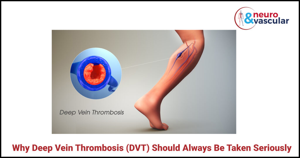Why Deep Vein Thrombosis (DVT) Should Always Be Taken Seriously