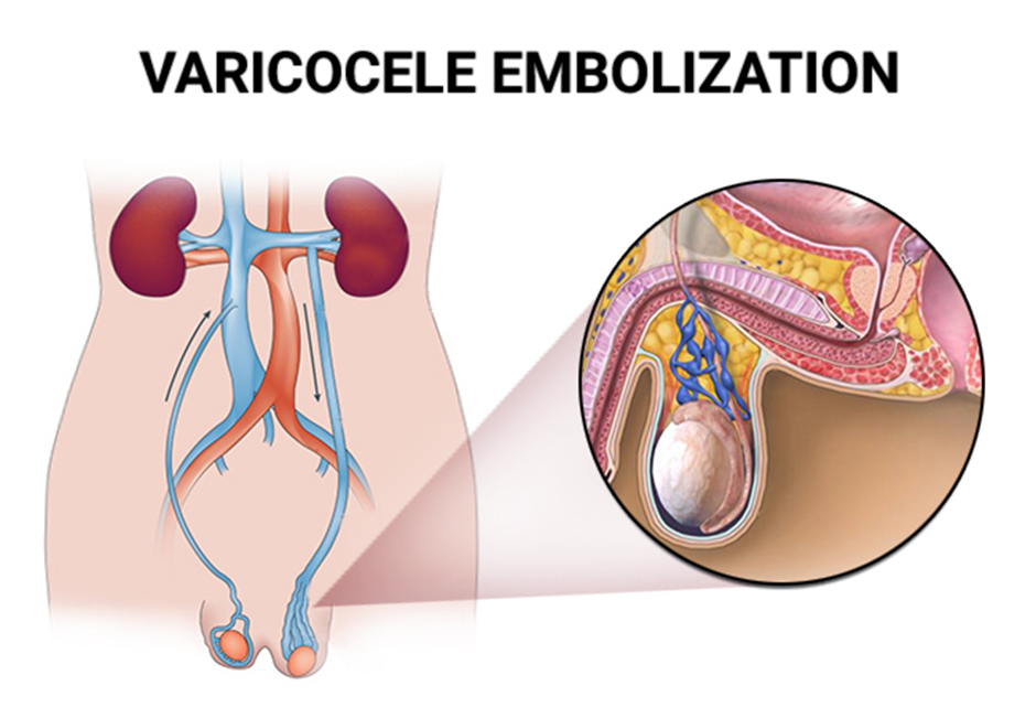 Varicocele: Common Cause of Male Infertility & its Treatment - SCI  International Hospital