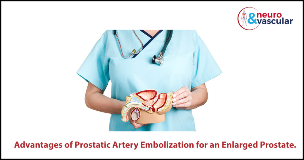 Advantages of Prostatic Artery Embolization for an Enlarged Prostate