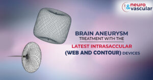 Brain Aneurysm Treatment with the latest Intrasaccular Web and Contour Devices What is brain aneurysm?