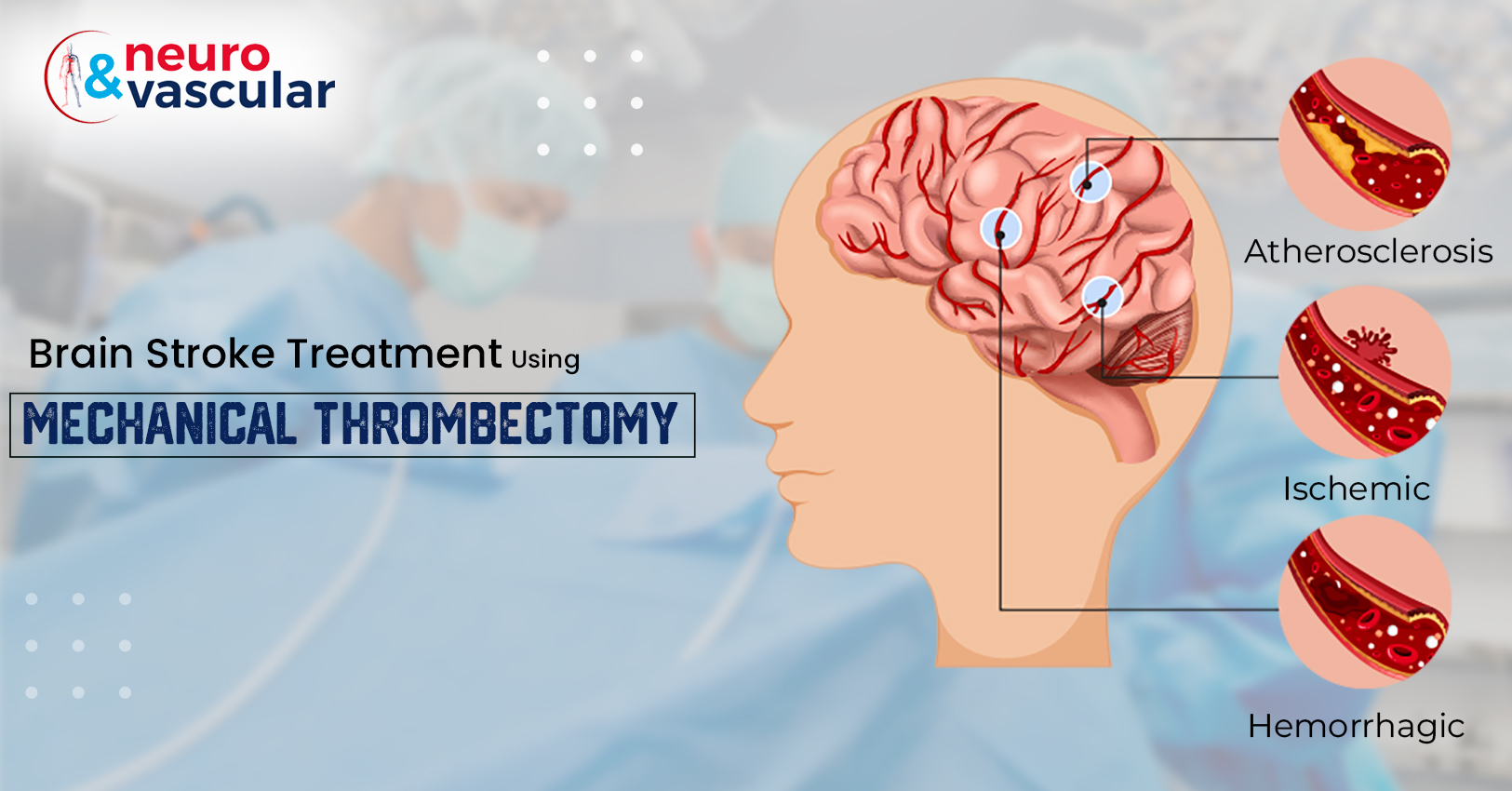 Brain Stroke Treatment using Mechanical Thrombectomy
