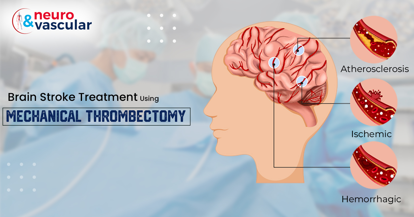 brain-stroke-treatment-using-mechanical-thrombectomy