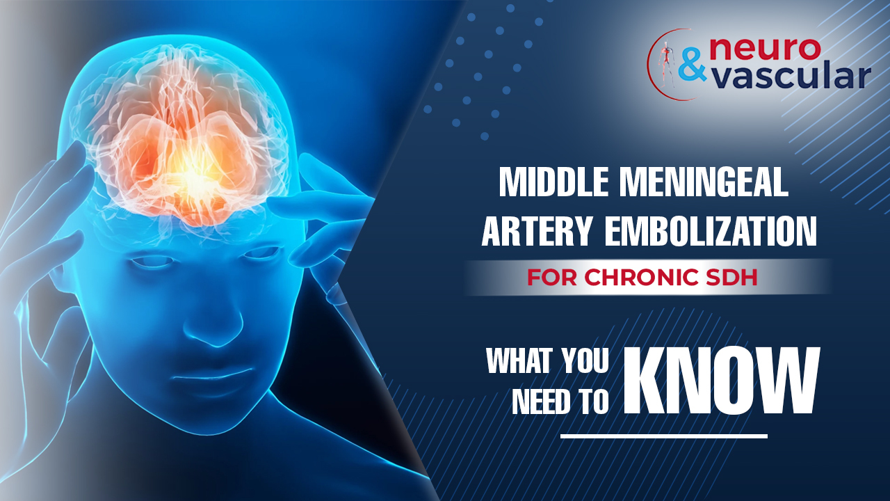 Middle Meningeal Artery Embolization for Chronic SDH: What You Need to Know