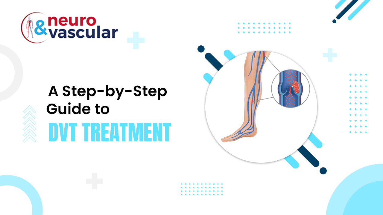 A Step-by-Step Guide to DVT Treatment