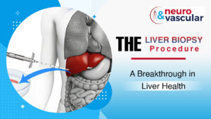 The Liver Biopsy Procedure: A Breakthrough in Liver Health