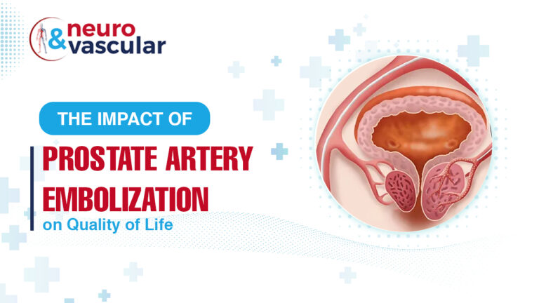 The Impact Of Prostate Artery Embolization On Quality Of Life 0211