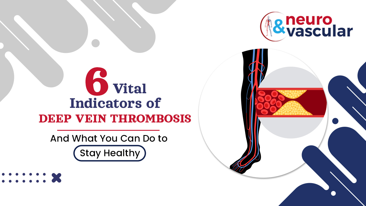 Deep Vein thrombosis Treatment in Hyderabad, DVT Treatments in Hyderabad, Radiofrequency Ablation Treatments in Hyderabad, Varicose Veins Treatment in Hyderabad