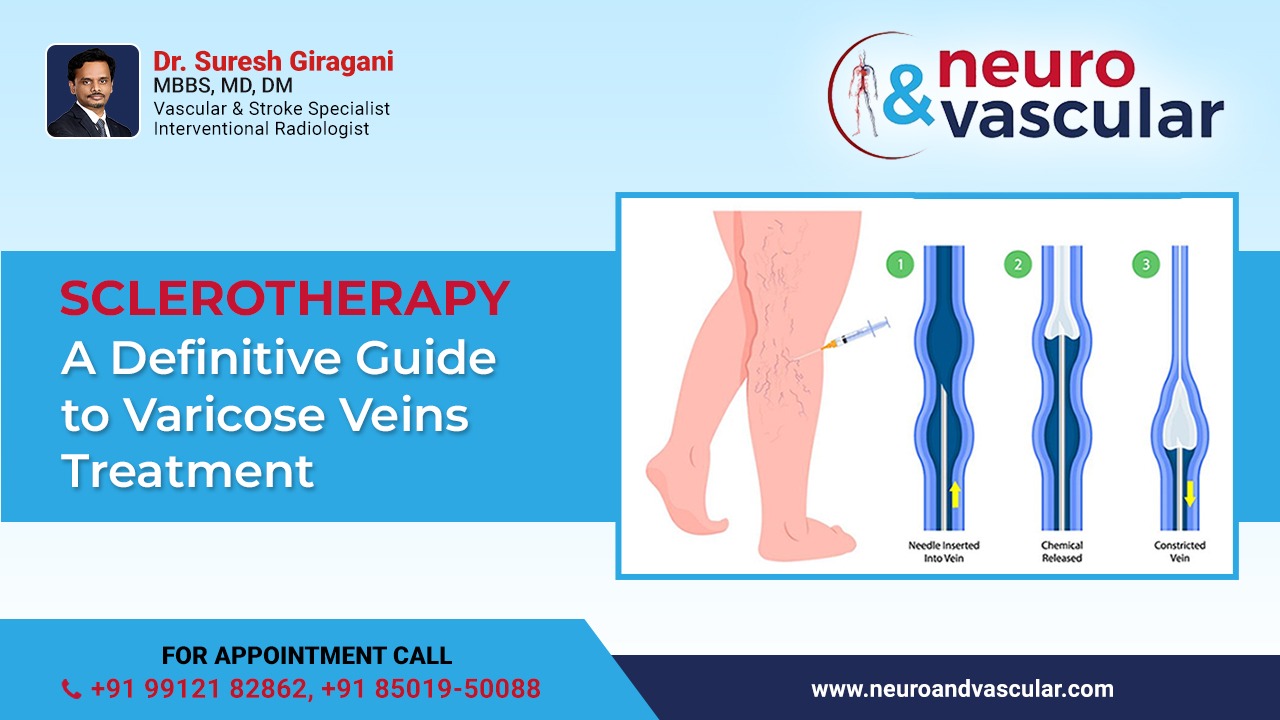 Sclerotherapy: A Definitive Guide to Varicose Veins Treatment