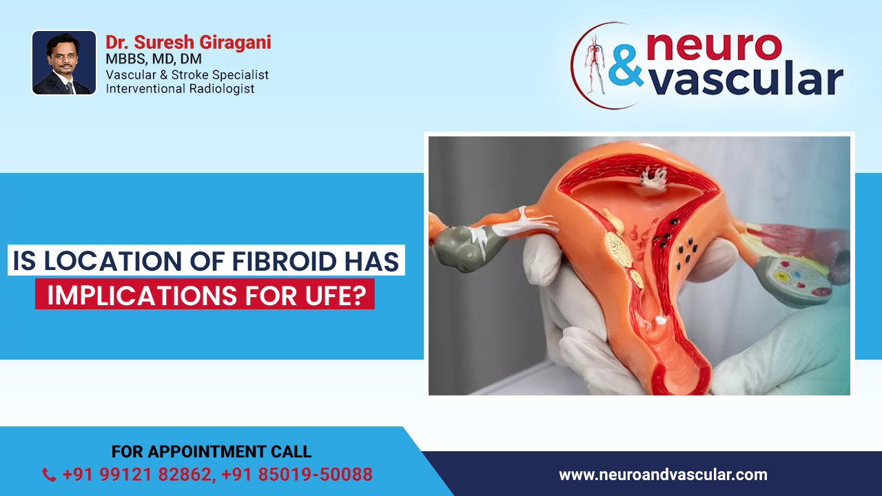 Is location of fibroid has implications for UFE?