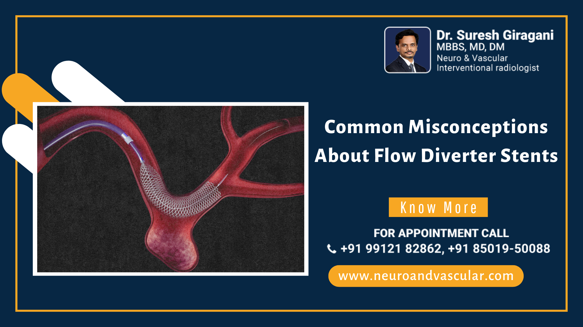 Common Misconceptions About Flow Diverter Stents